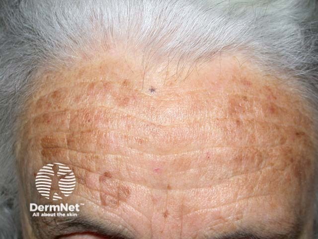 Diffuse lentiginosis