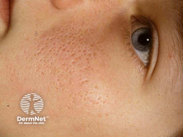 Keratosis pilaris atrophicans faciei