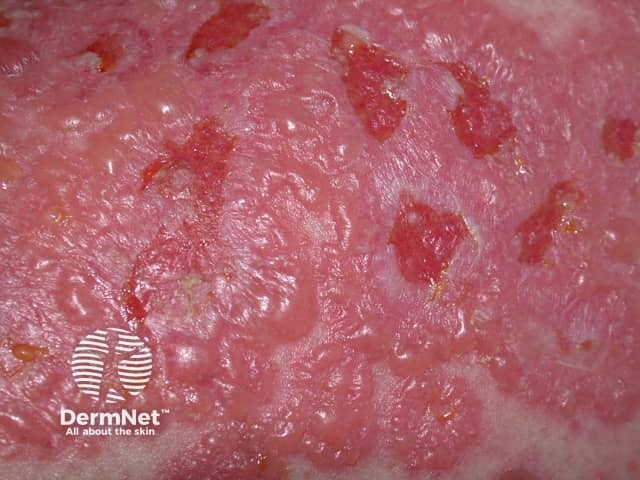 Drug-induced linear IgA disease