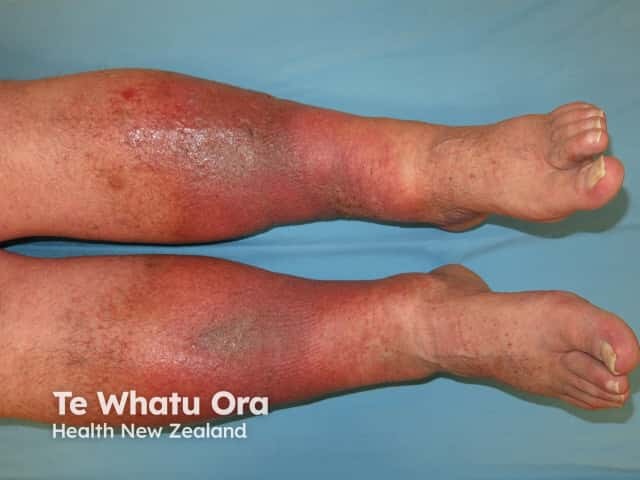 Venous eczema and lipodermatosclerosis