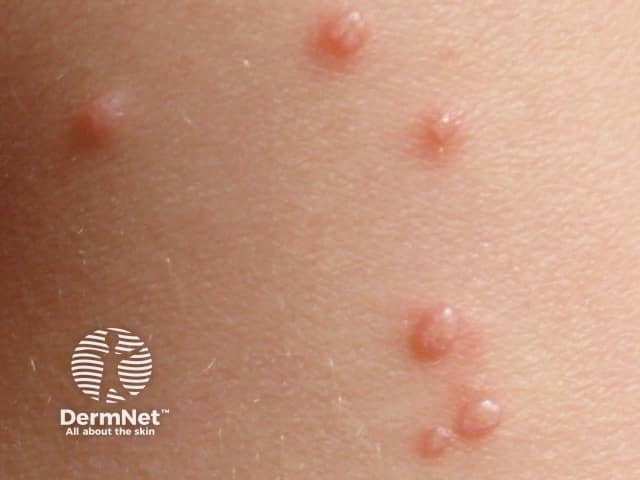 Molluscum contagiosum
