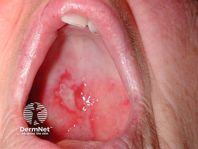 A palatal erosion due to MMP