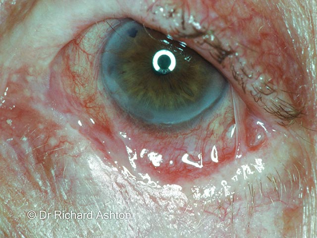 Conjunctival symblepharon due to MMP