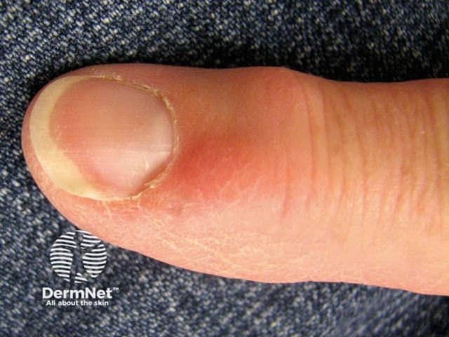 Heberden node and myxoid pseudocyst