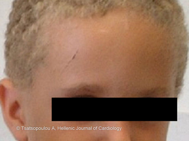 Wooly hair in Naxos disease