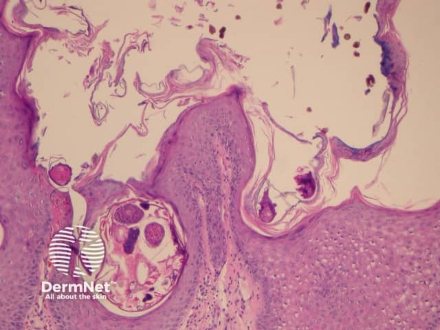 Scabies mites and eggs on palmar biopsy