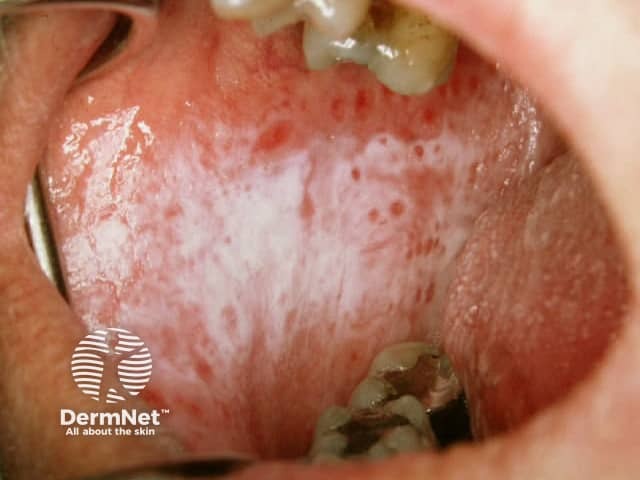 Plaque lichen planus