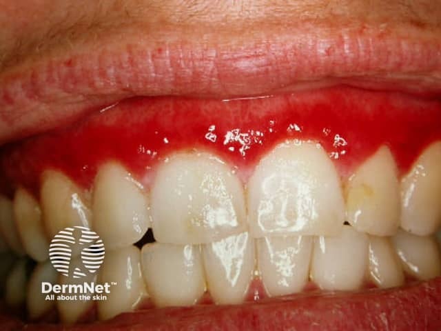 Erosive lichen planus