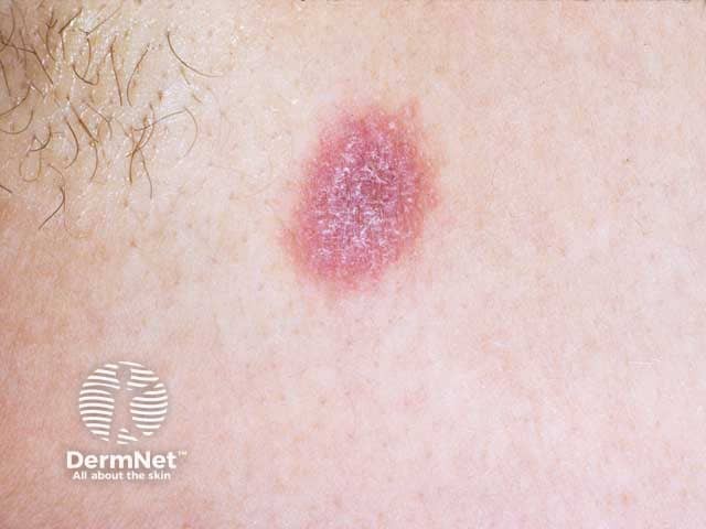 A plaque of lichen planus showing Wickham striae