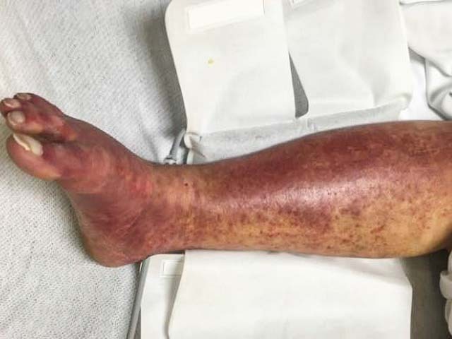 Papular purpuric gloves and socks syndrome: EBV