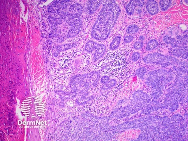 Pathology of basal cell carcinoma