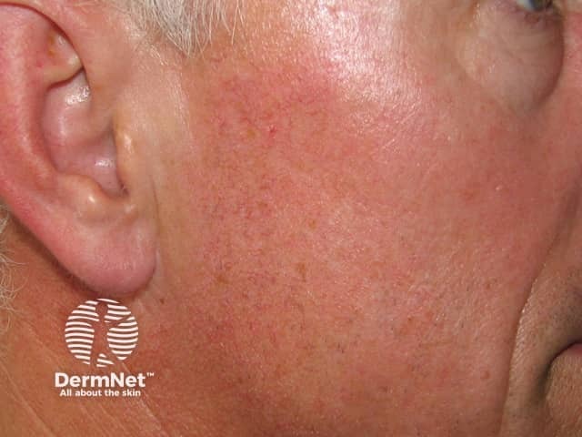 Pulse dye laser for telangiectasia, 2 weeks later