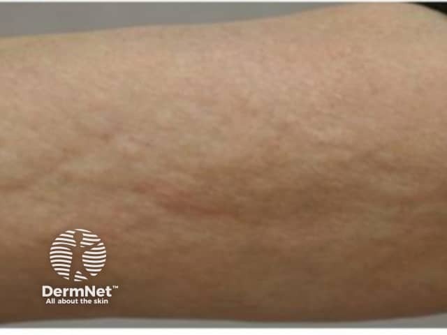 Eosinophilic fasciitis