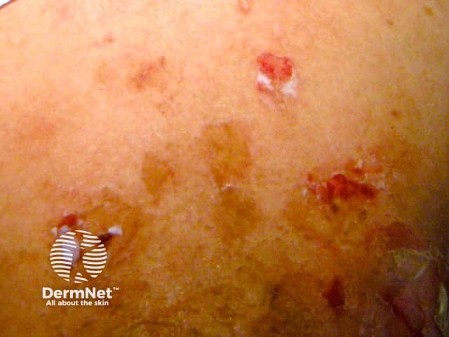 Drug-induced pemphigus