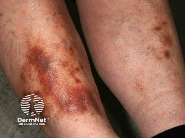 Pigmented purpuric dermatitis
