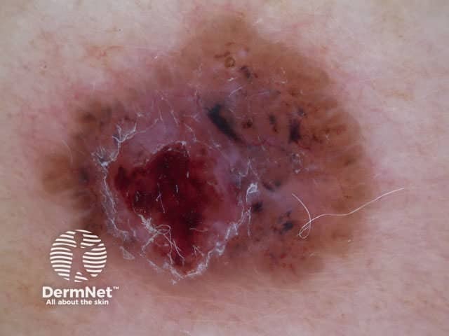 Adherent fibre, leaf-like structures and serpentine vessels in pigmented basal cell carcinoma dermoscopy