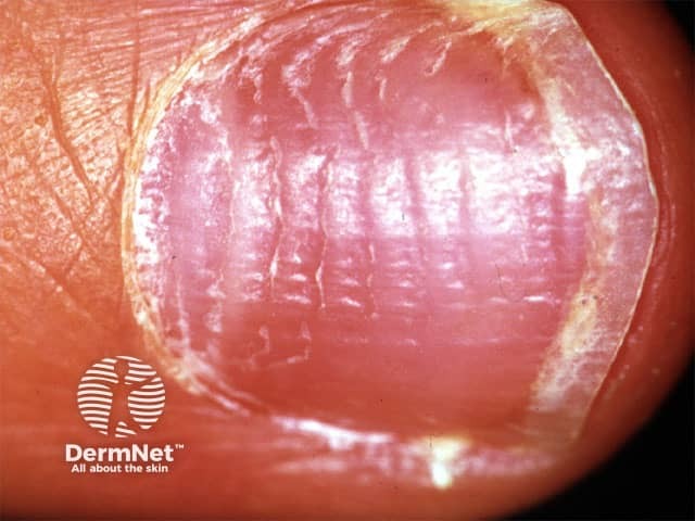 Alopecia areata nail pitting