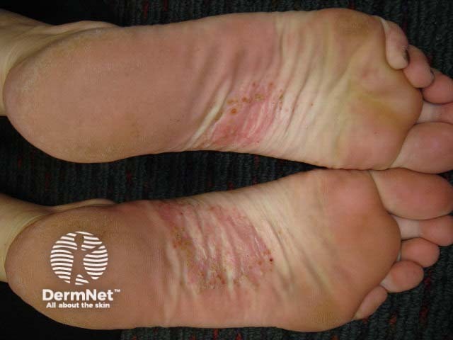 Plantar pustulosis