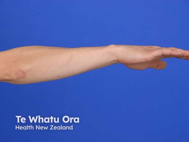 Well-circumscribed red scaly plaques - central clearing may even progress to produce annular plaques