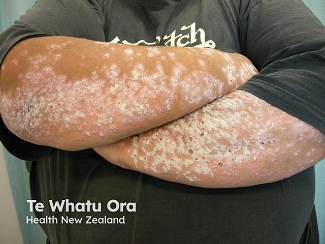 The silvery scaly plaques of extensive plaque psoriasis