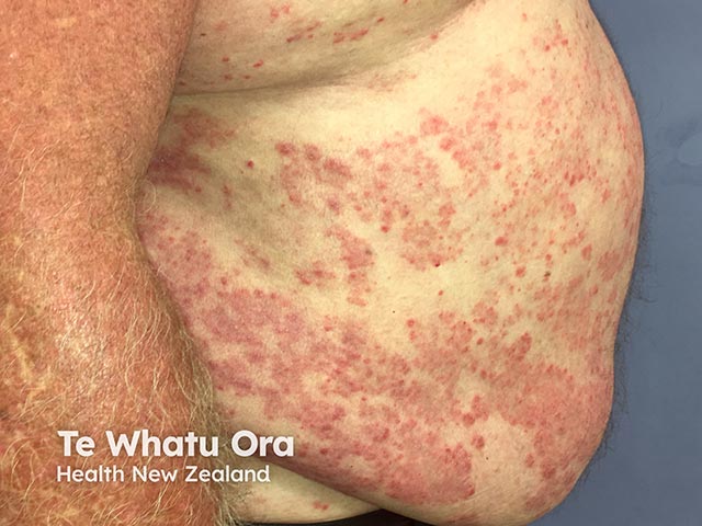 Chronic plaque psoriasis on the abdomen