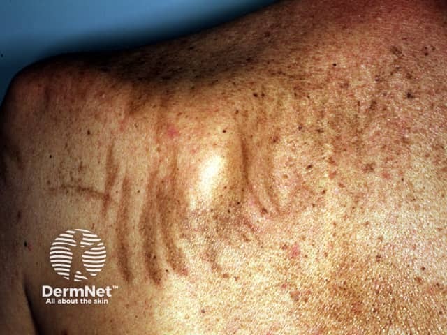 Flagellate reaction to bleomycin