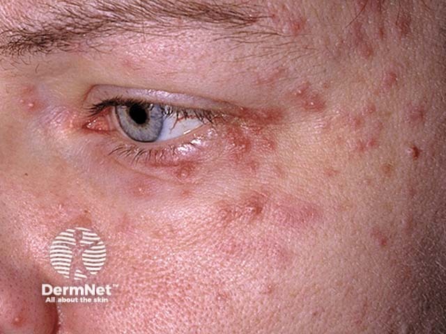 Pustules due to potassium iodide
