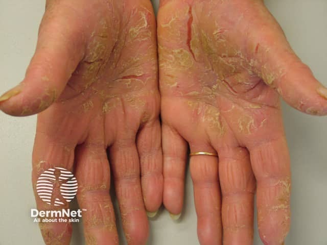 Keratoderma of the palms due to psoriasis