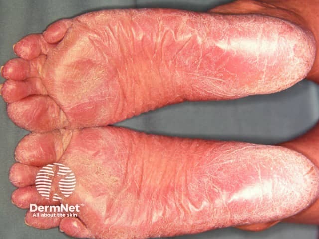 Palmoplantar psoriasis
