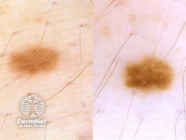 Dermoscopic change in a melanocytic naevus in pregnancy