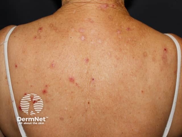 Pruritus due to iron deficiency