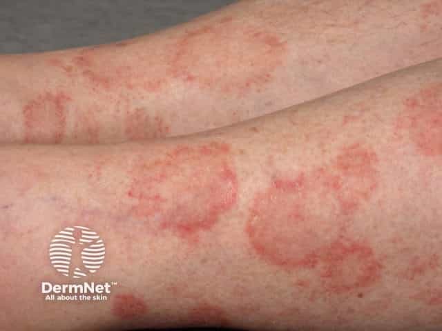 Pigmented purpuric dermatitis