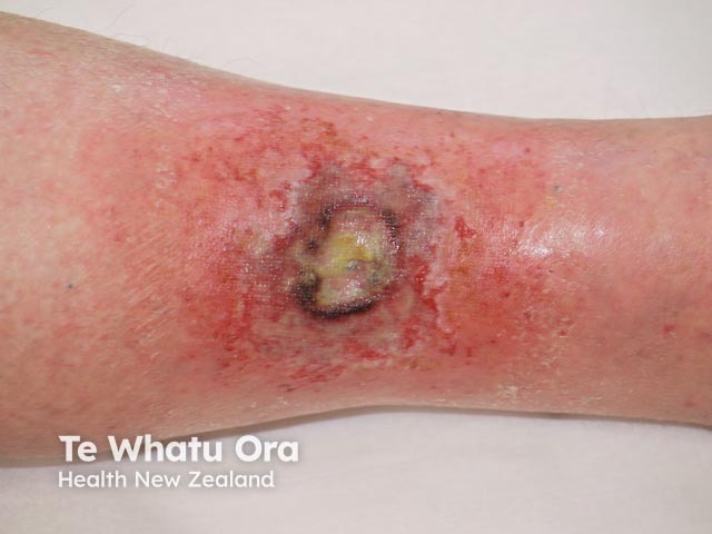 Acute radiation dermatitis