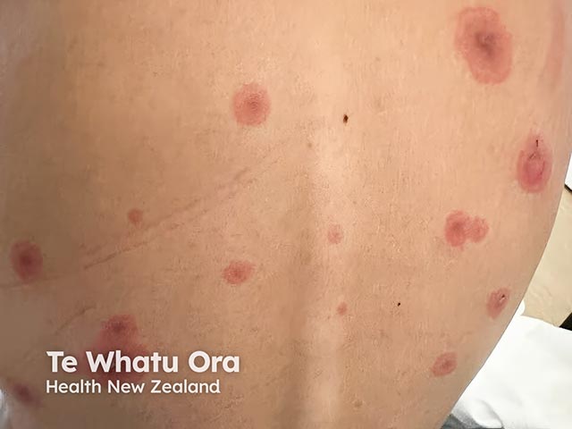 Reactive infectious mucocutaneous eruption (RIME)