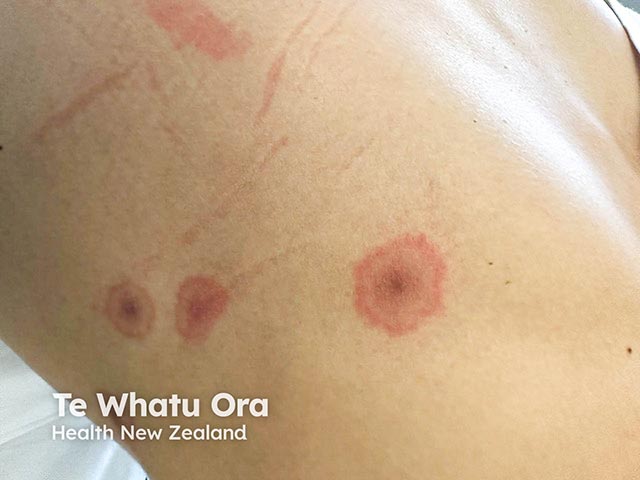 Target lesions on the back in reactive mucocutaneous eruption due to mycoplasma