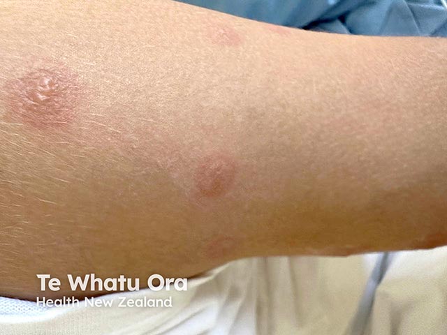 Target lesions on the limb in reactive mucocutaneous eruption due to mycoplasma