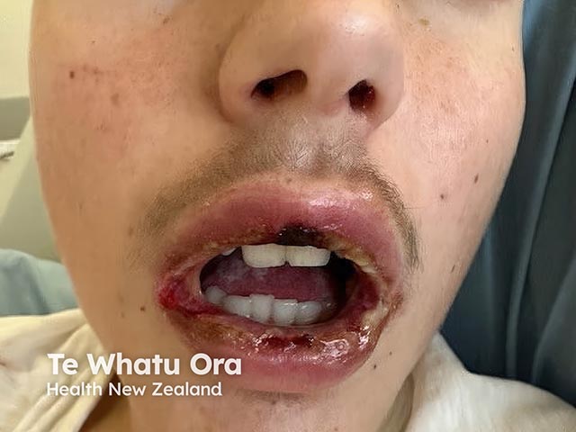 Haemorrhagic erosions and crusts in RIME