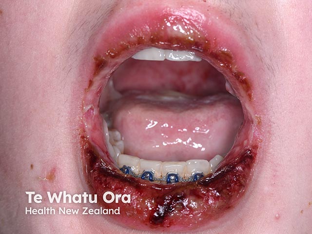 Haemorrhagic erosions on the lips in RIME due to mycoplasma