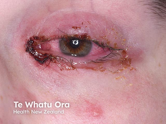 Severe conjunctival lesions in RIME