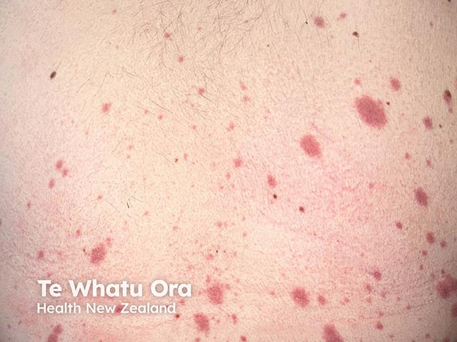 Early truncal plaques due to RIME