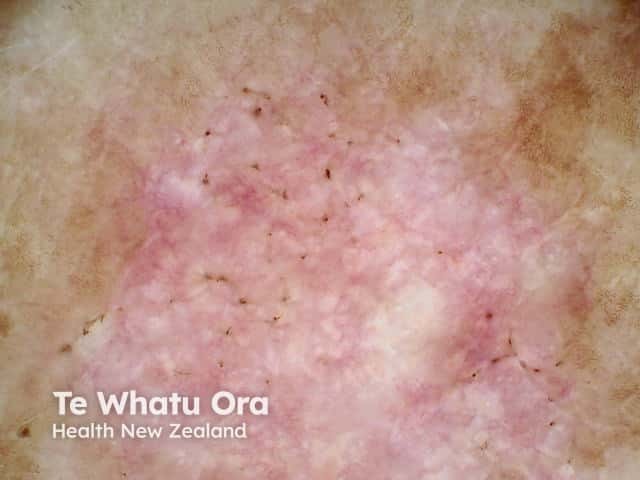 Right Posterior Upper Arm