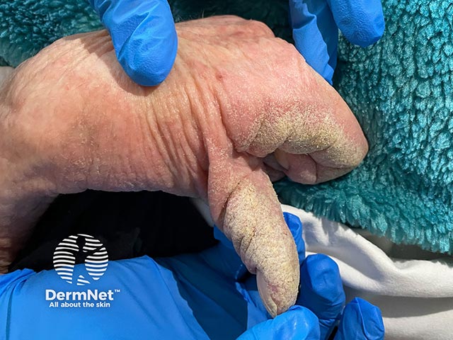 Crusted scabies causing a keratoderma