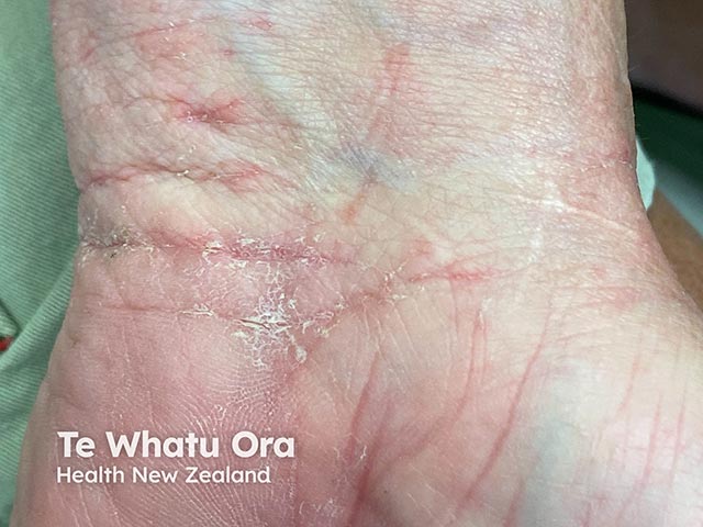 Scaling and a burrow on the volar wrist due to scabies