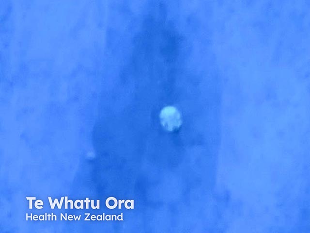 A scabies mite identified with a UV illuminated dermatoscope