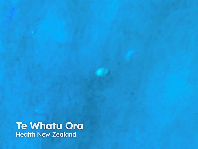 A scabies mite identified with a UV illuminated dermatoscope