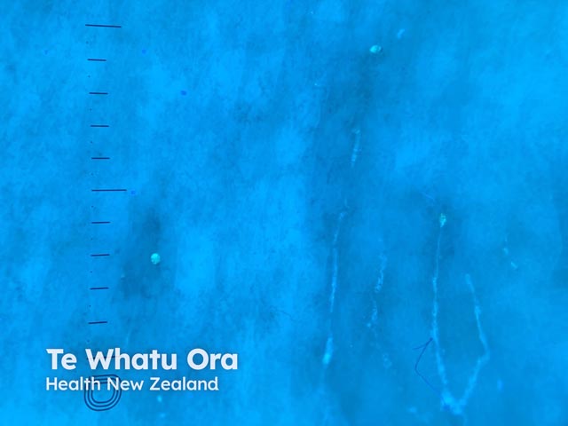 A scabies mite identified with a UV illuminated dermatoscope