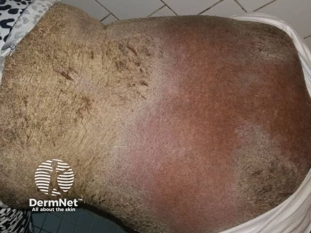 Hyperkeratosis has extended over the trunk