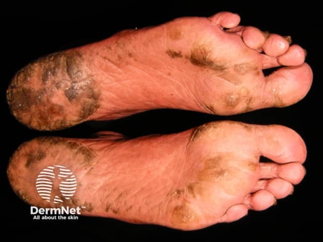 Plantar keratoderma
