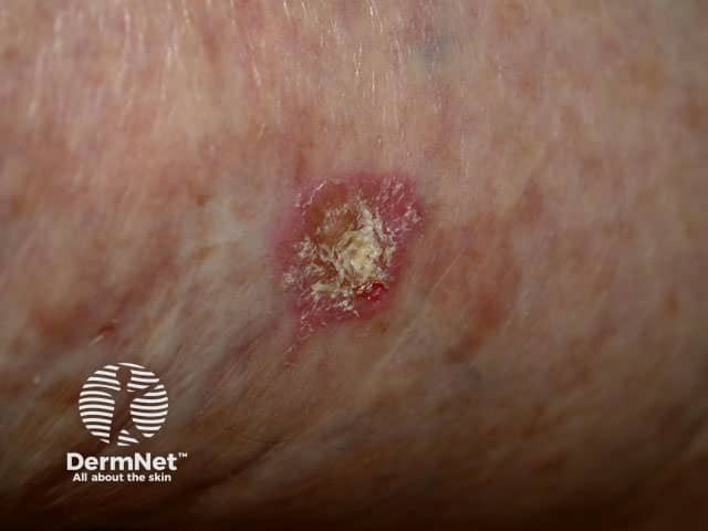 Actinic keratosis
