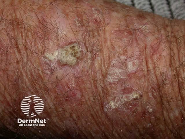 Actinic keratosis